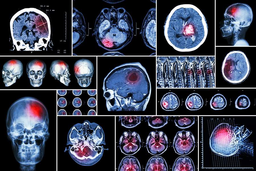 Recovery Predicted In Concussion Patients By New Imaging System