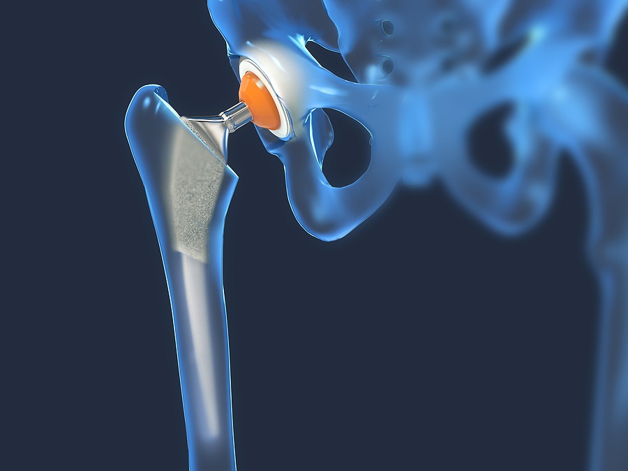 defective hip implant